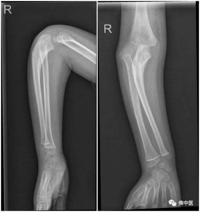 才巴术前右前臂全长侧位及正位x光