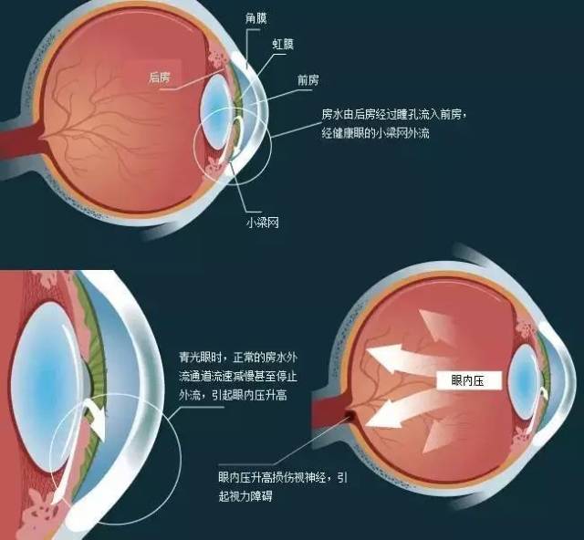 眼压升高是引起视神经,视野损害的主要危险,眼压越高导致视神经损害的