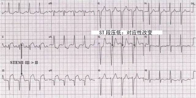 ①本图呈窦性心动过速,电轴偏左,avf导联呈病理性q波,伴st段抬高