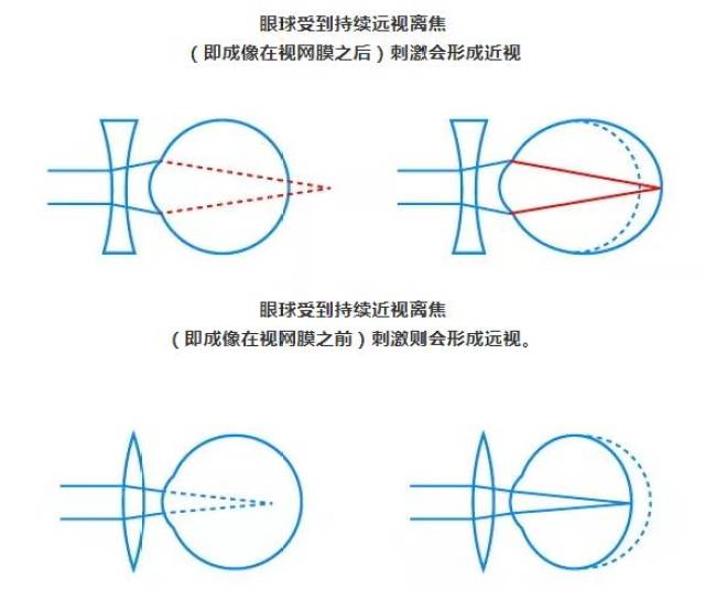 多视点近视控制又添可靠新手段—新乐学多点近视离焦镜