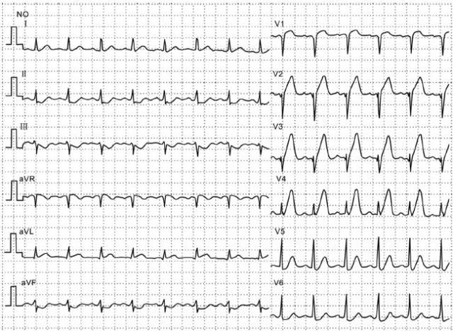 下面,我们通过病例,来复习一下心梗的不型心电图表现.