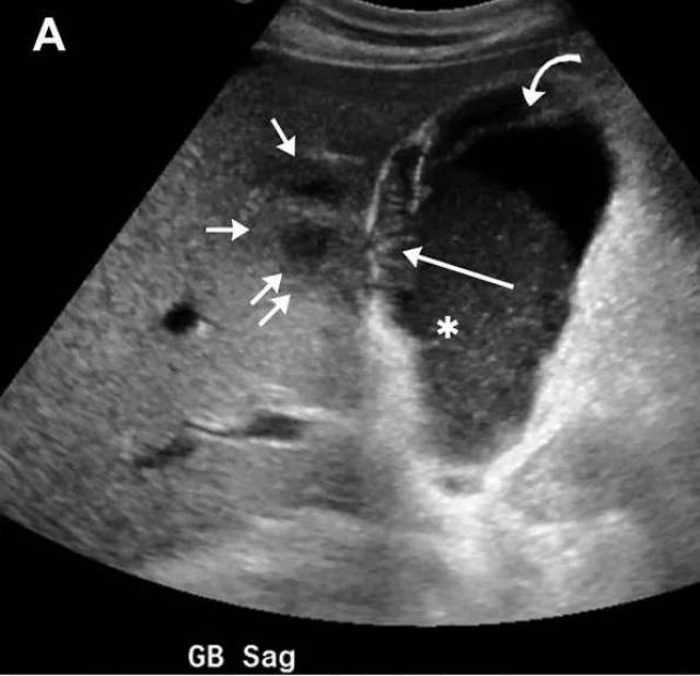 图1 72 岁男性急性胆囊炎,墨菲斯征( ),超声表现为胆囊增大,宽径>4 cm