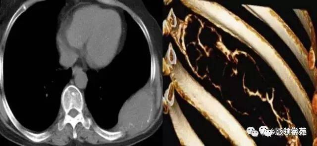 发生在肋骨上的15种肿瘤,您都见过吗?