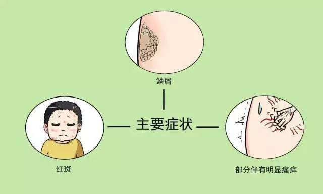 银屑病关节炎治疗新方法,快来围观,可获得免费用药机会!