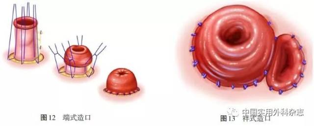 固定造口,造口约高于皮肤1～2 cm;袢式造口中可使用弹性或刚性支撑棒