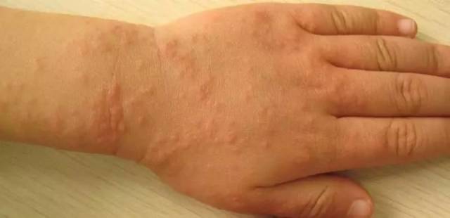 你家的宝宝可能患的是沙土皮疹,又称为丘疹性皮疹,摩擦苔藓样疹.