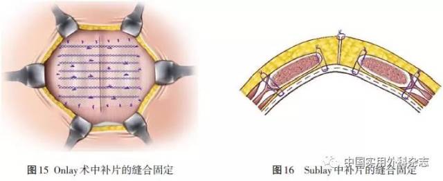 1 缝合技术:补片缝合固定的方法有2种:(1)经皮全层缝合固定(悬吊法)