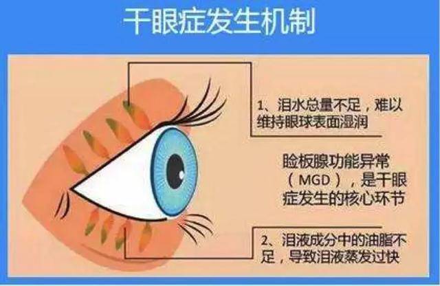 如何有效治疗干眼症