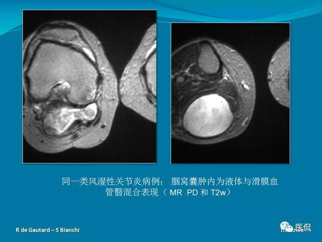 膝关节最常见的疾病:囊性损伤和滑膜病变的影像诊断