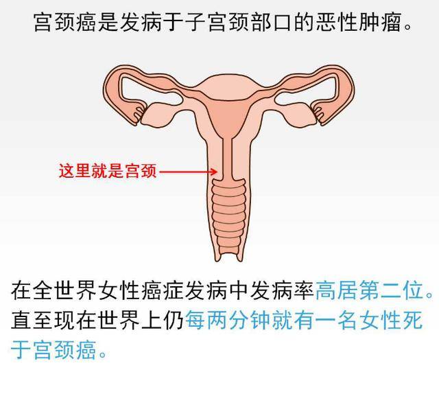 宫颈癌是女性最常见的妇科的恶性肿瘤,也成为危害女性健康最大的因素.