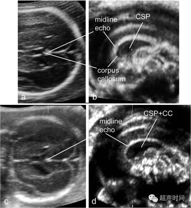 超声如何完美显示胎儿胼胝体