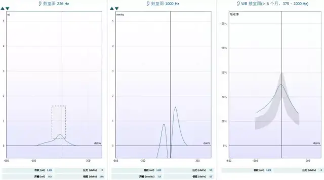 【宽频声导抗】