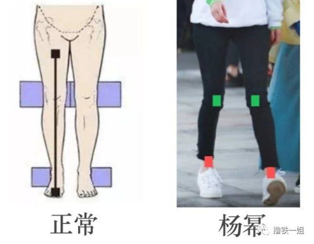 这腿真的变形到撑不住身体了!
