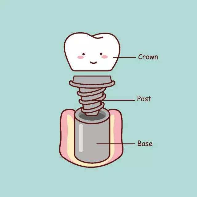 牙齿种植,简单又复杂,关于种植牙你了解