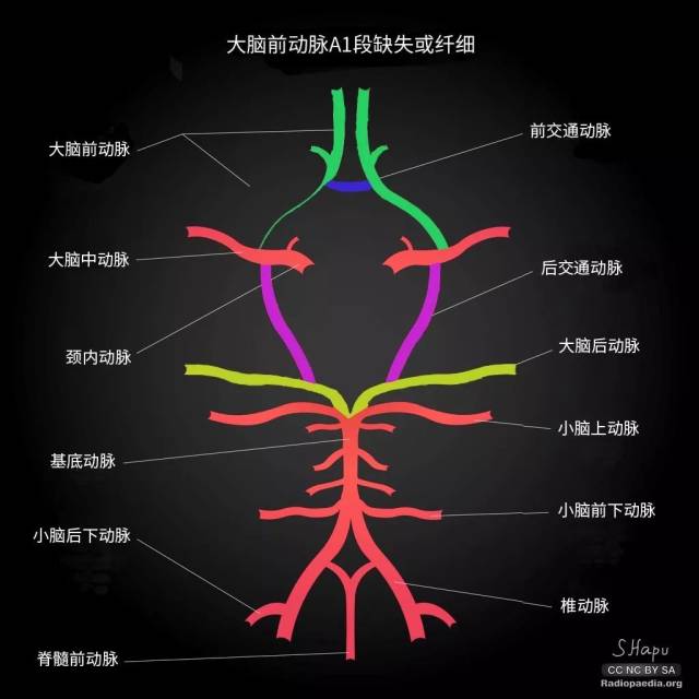 10%的willis环可见胚胎型大脑后动脉;6%的willis环由于缺少后交通动脉