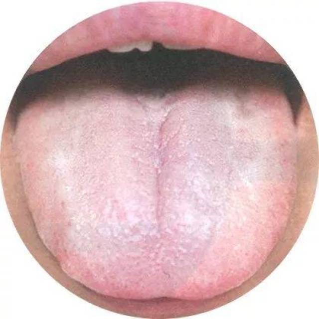舌诊| 八大体质典型舌象之气虚体质[中医干货]