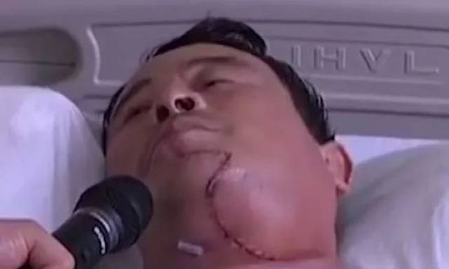来自湖南的谭先生因常年嚼槟榔,罹患口腔癌,成为"割脸人"