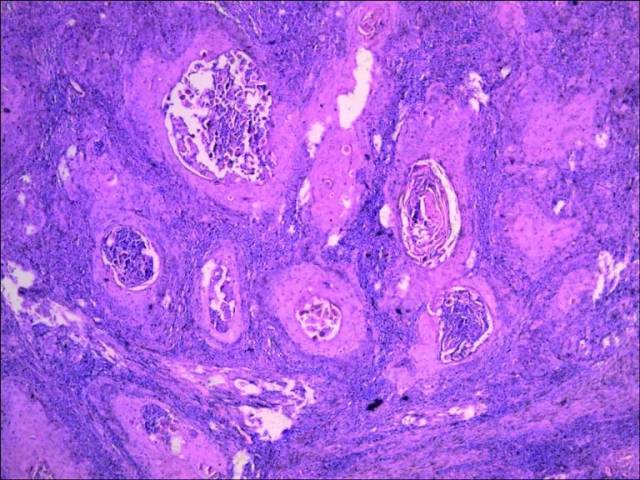 嗜酸性的高分化鳞状细胞构成(图1),可见细胞间桥或角化珠(图2),癌灶侵