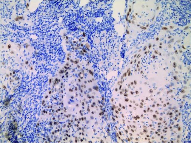 质丰富,嗜酸性的高分化鳞状细胞构成(图1),可见细胞间桥或角化珠(图2)