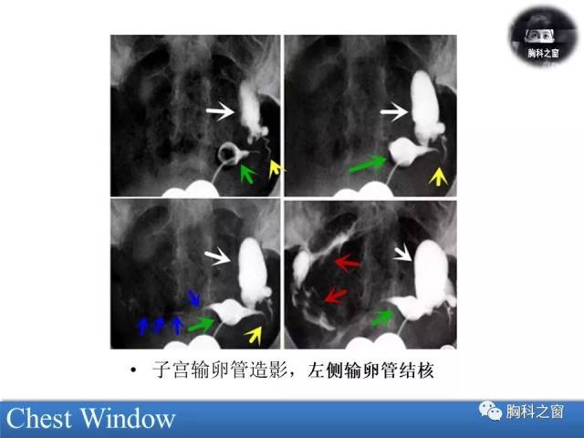 输卵管结核常累及双侧,可无任何症状,常在治疗不孕症或宫外孕时