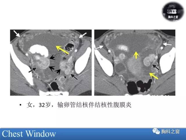 输卵管结核常累及双侧,可无任何症状,常在治疗不孕症或宫外孕时