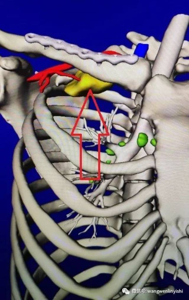 图2,x线显示右侧锁骨的固定钢板. 图10,肿瘤与周围结构的关系.
