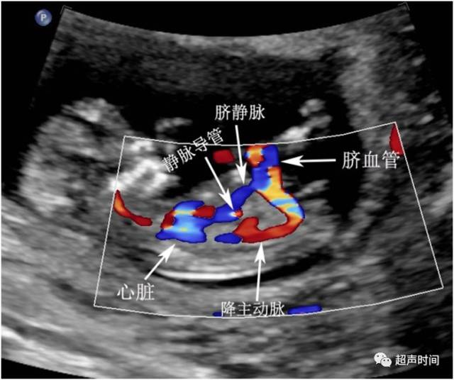 孕早期超声扫查规范(fmf 版):静脉导管血流