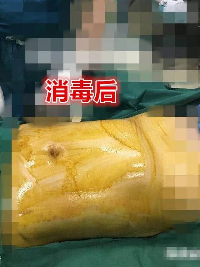 杨幂自曝抽2斤脂肪!女星同一部位的伤口,埋线100根都救不回