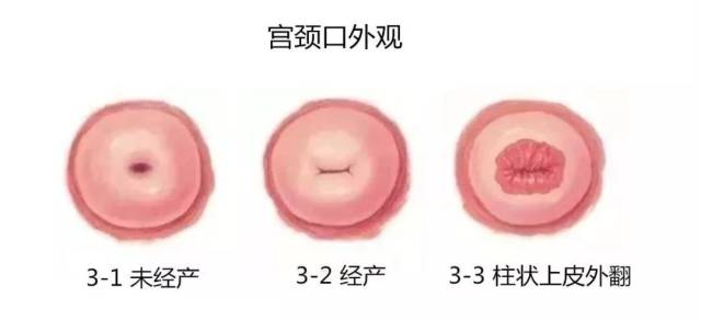 宫颈口外观 图3是妇科检查下所见到的正常的及"柱状上皮外翻"的宫颈口