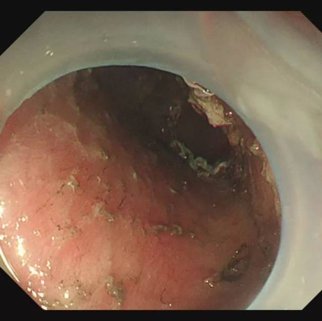 【医学科普】消化内镜下食管早癌的治疗