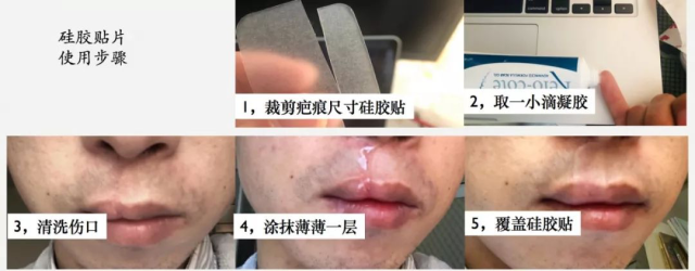 郑州最新胎记去除动态：精准医疗与传统疗法并举