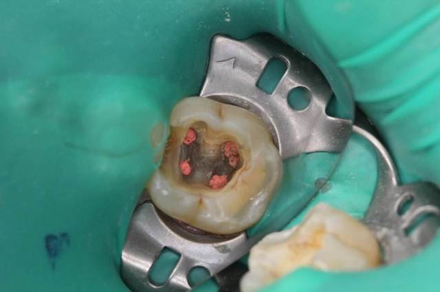 2,根管治疗 蛀牙后期,黑色牙体超过一半烂掉,伤到牙神经疼起来真要命