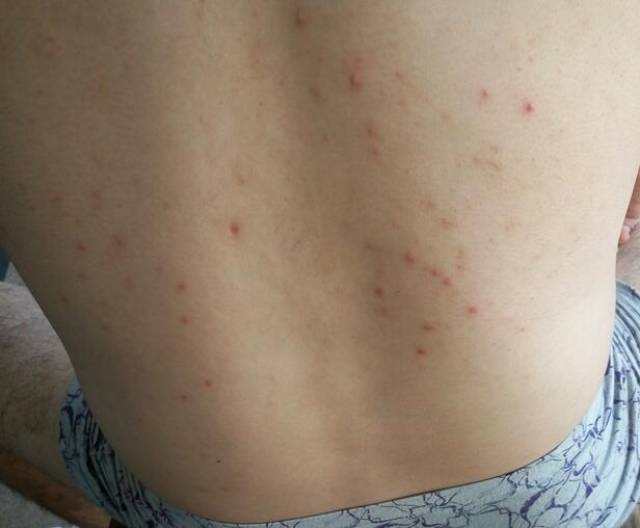 4,背上的螨虫过多也会时不时造成瘙痒的症状,白天的时候,皮肤瘙痒的