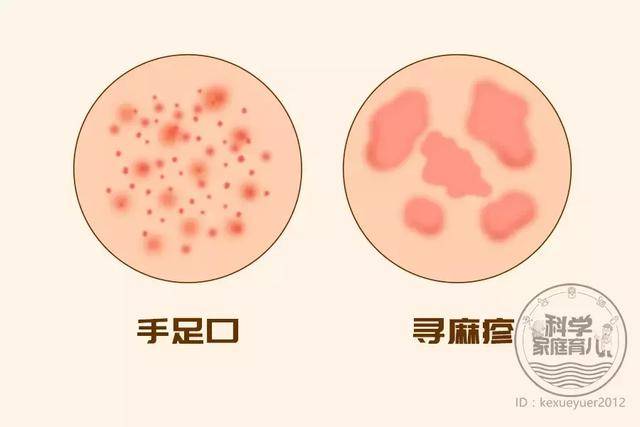 重大提醒4月是手足口病高发季抓紧时间打疫苗认清5大真相