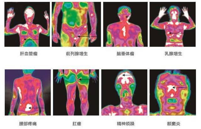 仅需180元即可做"中医热ct"全身检测.