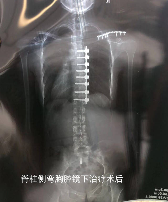 【案例】胸腔镜下微创脊柱侧弯矫形术