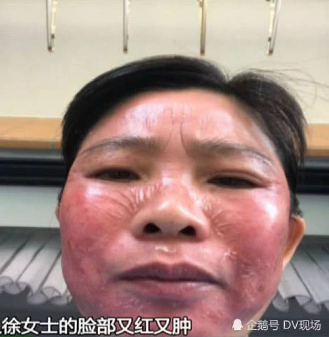 中山一女子去美容院做祛斑 结果竟然得了皮肤病