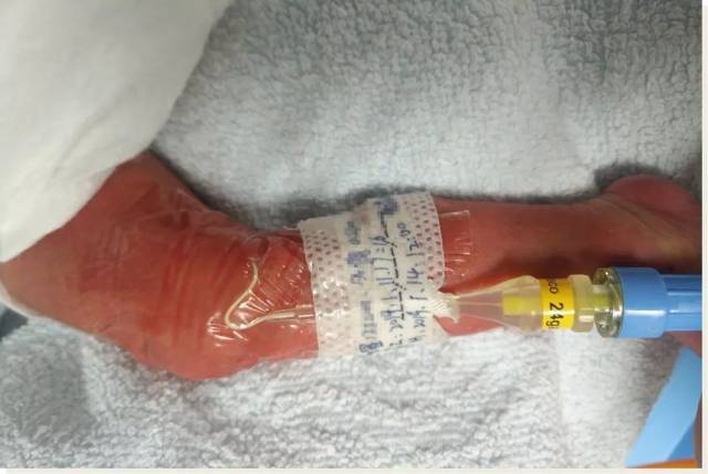 新生儿picc置管术,为早产宝宝生命助力!