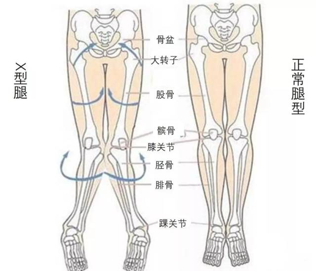 而且通常伴有内八字和足外翻的情况.