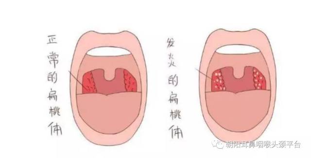 舌根处的舌扁桃体,两腭弓之间的腭扁桃体及咽鼓管口处的管扁桃体