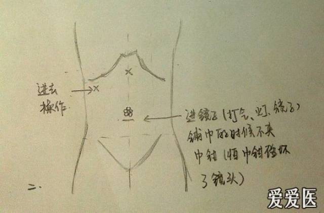 腹腔镜胆囊切除术(lc)的操作过程及要点 (转载)