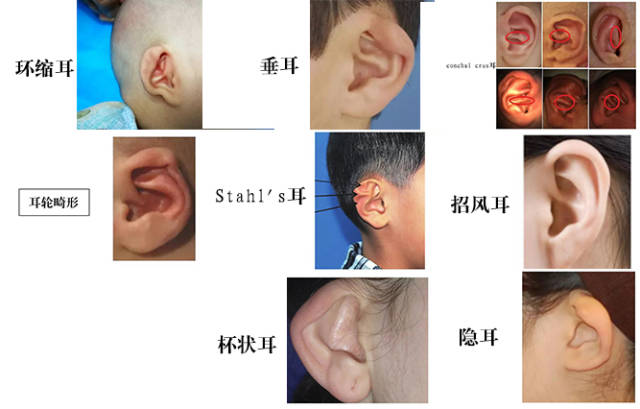 以下图片里面提到的8种外耳廓畸形都是可以通过佩戴矫正器进行无创