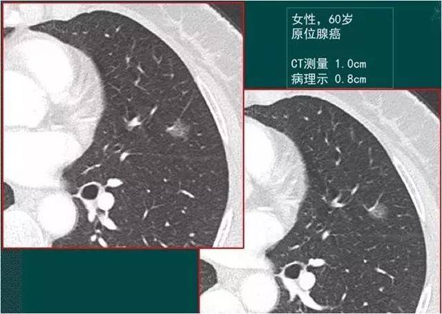 29岁女生查出肺腺癌,医生说幸亏她得了另一种病