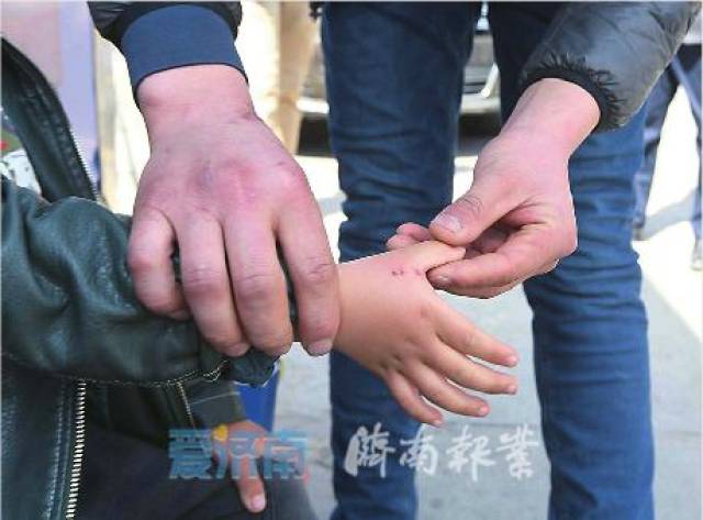 26日,在济南市传染病医院,王先生描述孩子被老鼠咬伤的情形.