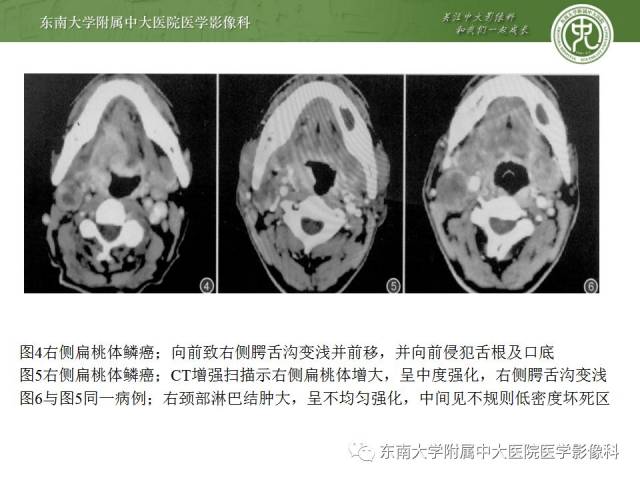 头颈部 扁桃体癌影像学表现