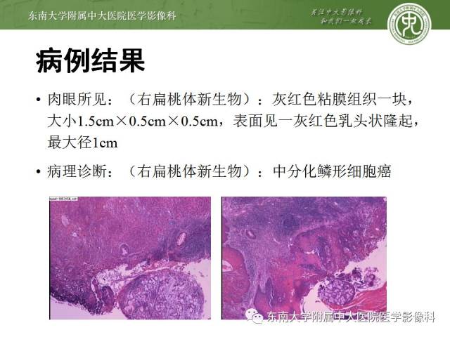 头颈部 | 扁桃体癌影像学表现