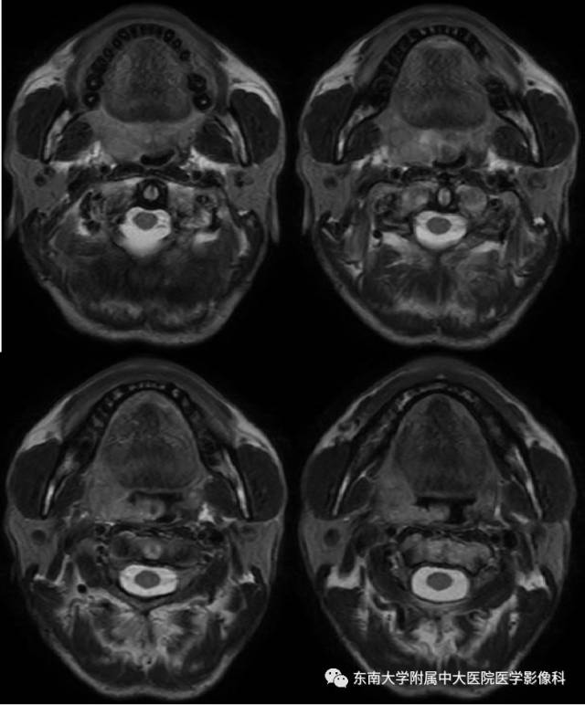 头颈部 | 扁桃体癌影像学表现