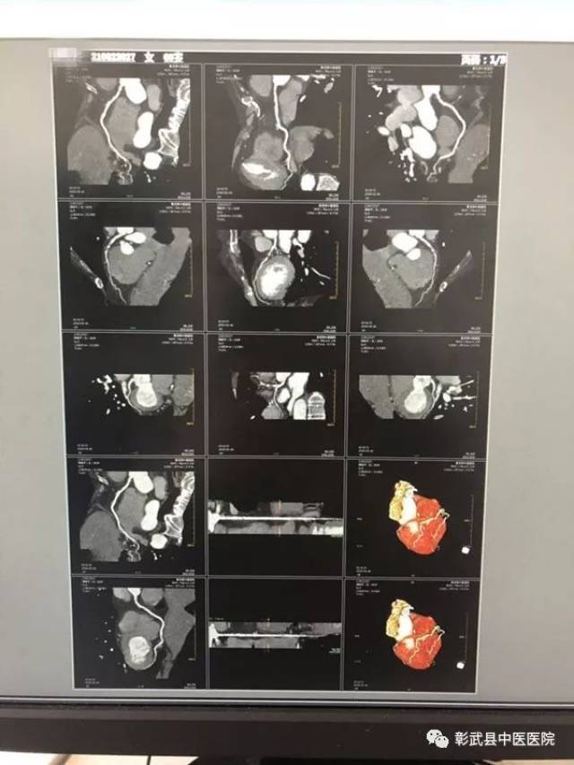 李晓丽医生接诊,建议患者做冠脉增强ct,确诊为冠心病,目前患者经过