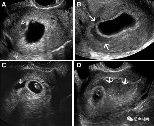 孕早期绒毛膜下血肿:超声评估方法和预后_手机搜狐网
