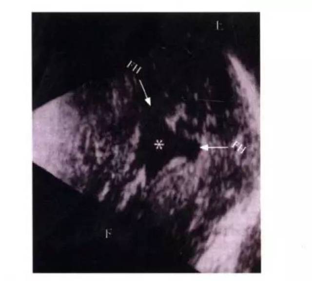 前脑无裂畸形:多图文超声解析